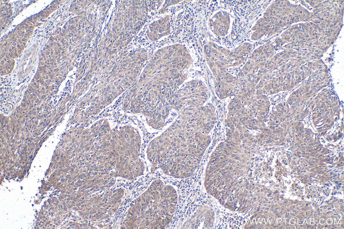 Immunohistochemical analysis of paraffin-embedded human cervical cancer tissue slide using KHC1895 (SMAD5 IHC Kit).
