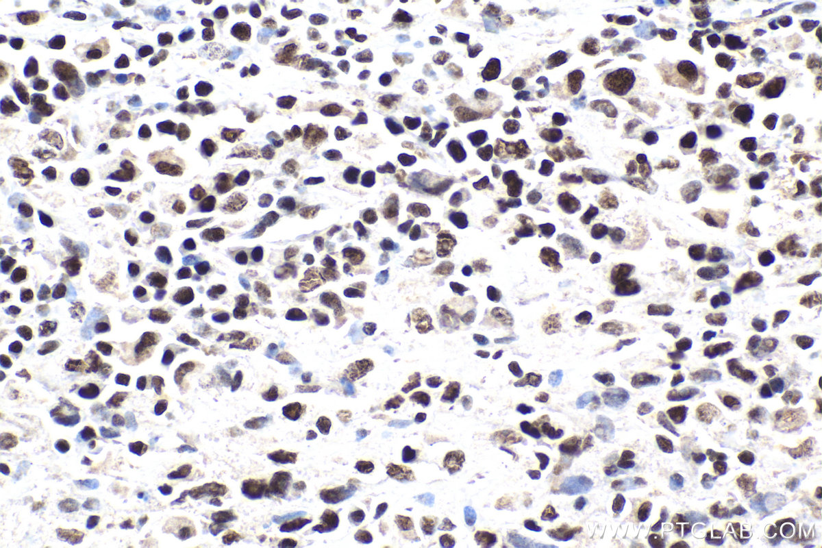 Immunohistochemical analysis of paraffin-embedded human malignant melanoma tissue slide using KHC1860 (SMARCC1 IHC Kit).