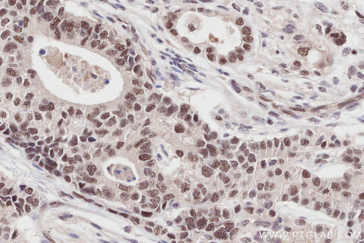Immunohistochemical analysis of paraffin-embedded human stomach cancer tissue slide using KHC2794 (SMARCD1 IHC Kit).