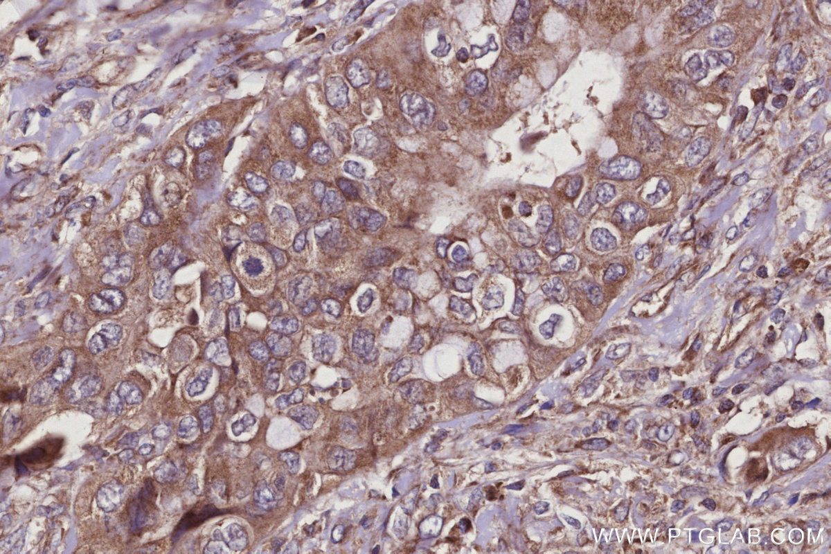 Immunohistochemical analysis of paraffin-embedded human pancreas cancer tissue slide using KHC2942 (SMCR7L/MID51 IHC Kit).