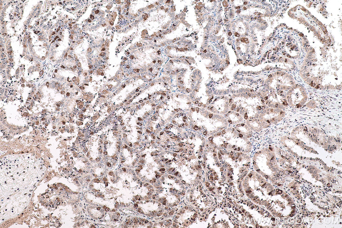 Immunohistochemical analysis of paraffin-embedded human ovary tumor tissue slide using KHC0769 (SMYD2 IHC Kit).