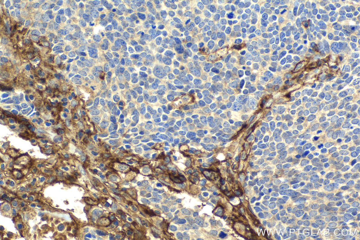 Immunohistochemical analysis of paraffin-embedded human lung cancer tissue slide using KHC2040 (SNAP23 IHC Kit).
