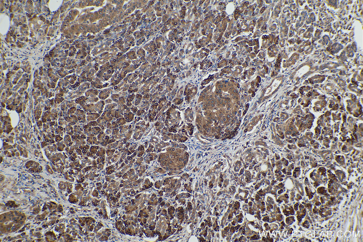 Immunohistochemical analysis of paraffin-embedded human pancreas cancer tissue slide using KHC0954 (SND1 IHC Kit).