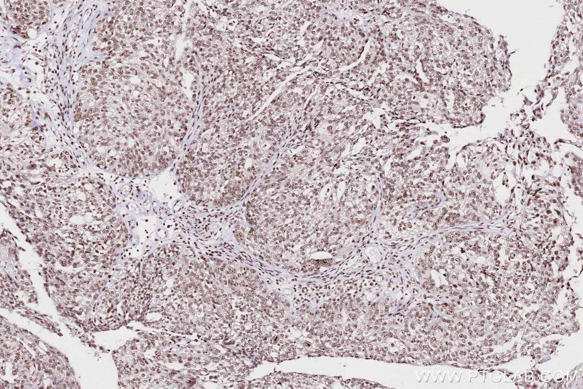 Immunohistochemical analysis of paraffin-embedded human ovary cancer tissue slide using KHC2703 (SNIP1 IHC Kit).