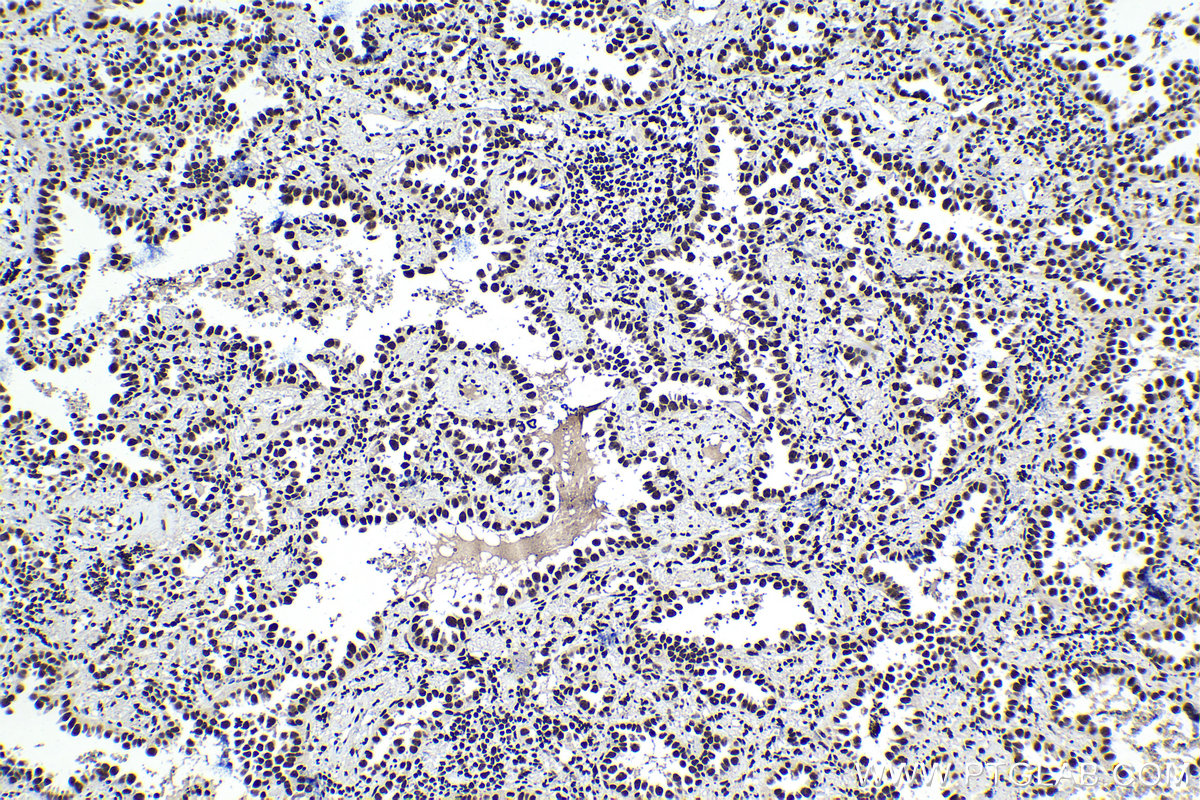 Immunohistochemical analysis of paraffin-embedded human lung cancer tissue slide using KHC1393 (SNRPD2 IHC Kit).