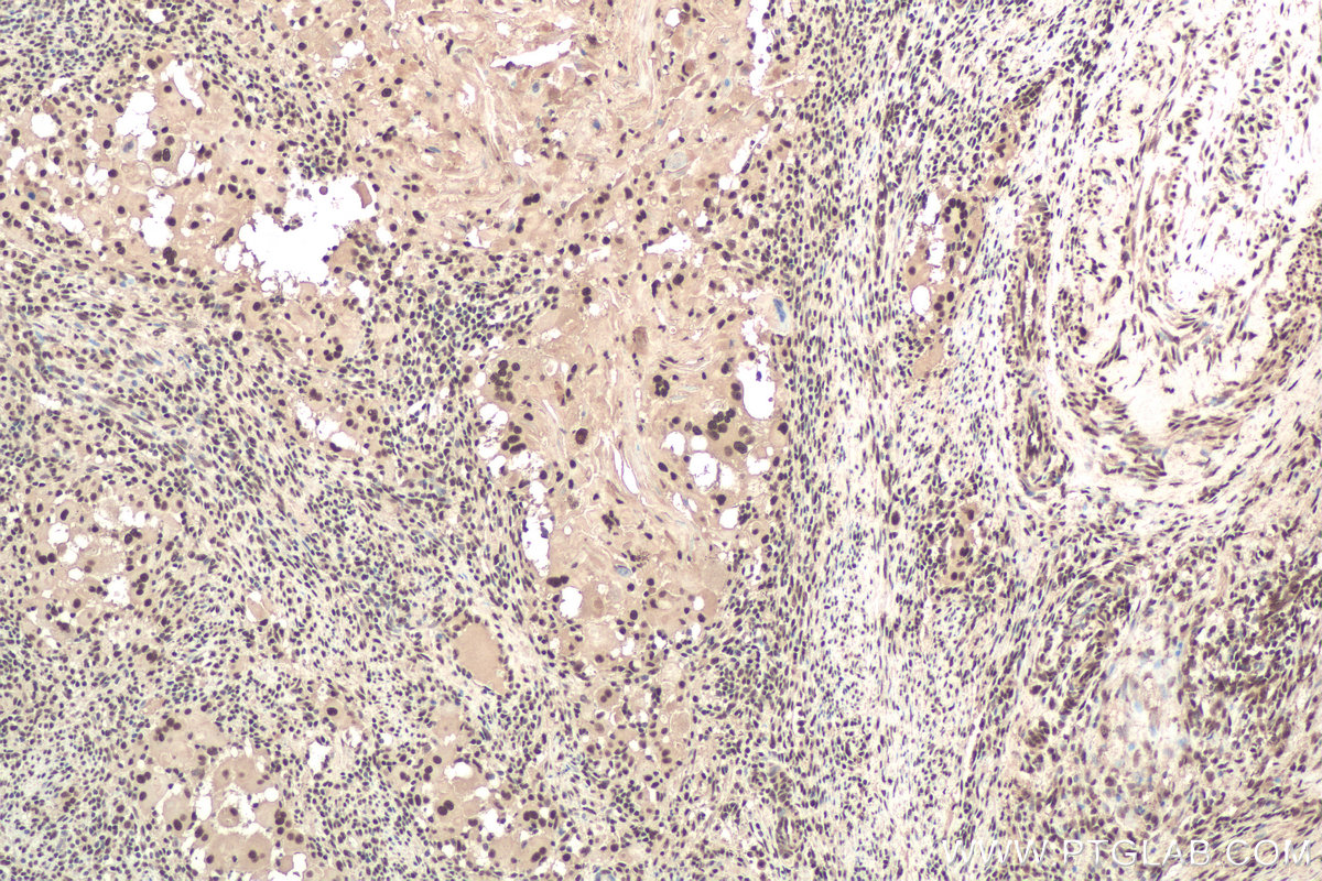 Immunohistochemical analysis of paraffin-embedded human cervical cancer tissue slide using KHC0882 (SNRPG IHC Kit).