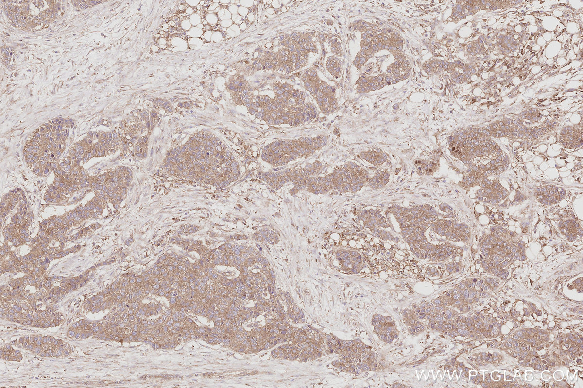 Immunohistochemical analysis of paraffin-embedded human stomach cancer tissue slide using KHC3084 (SNX9 IHC Kit).
