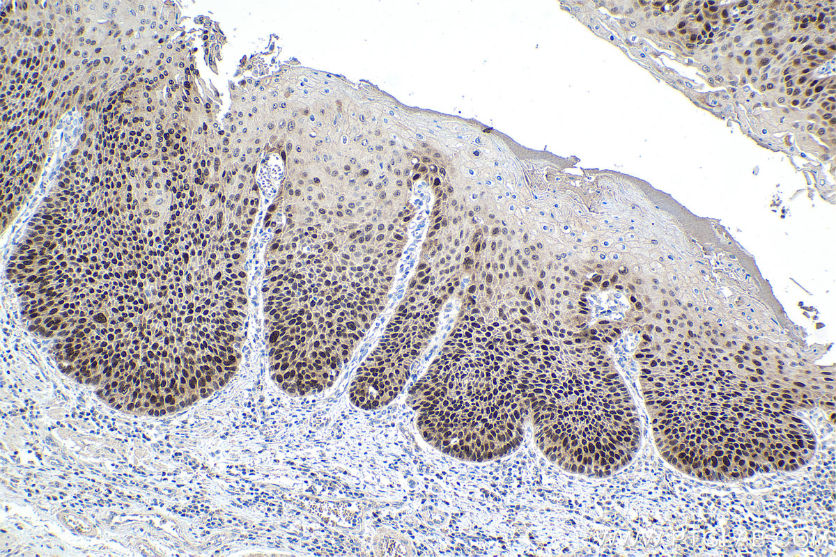 Immunohistochemical analysis of paraffin-embedded human oesophagus cancer tissue slide using KHC1461 (SOX15 IHC Kit).