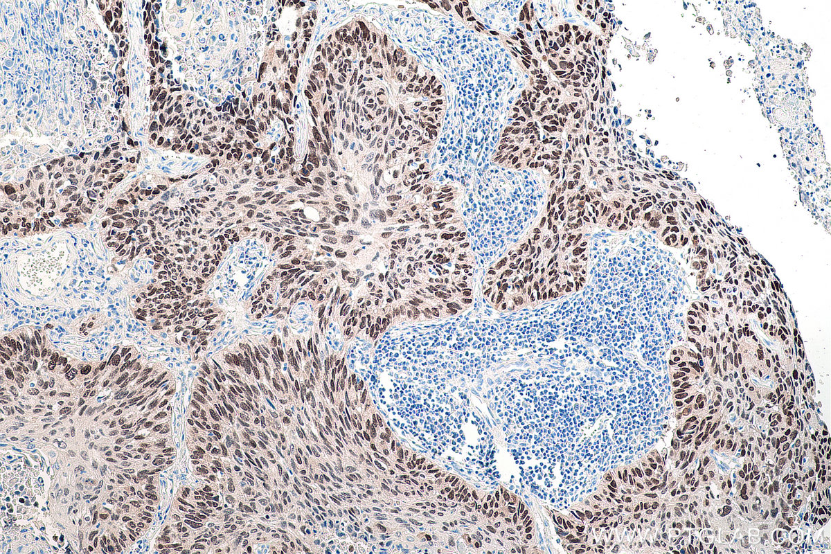 Immunohistochemical analysis of paraffin-embedded human lung cancer tissue slide using KHC0294 (SOX2 IHC Kit).