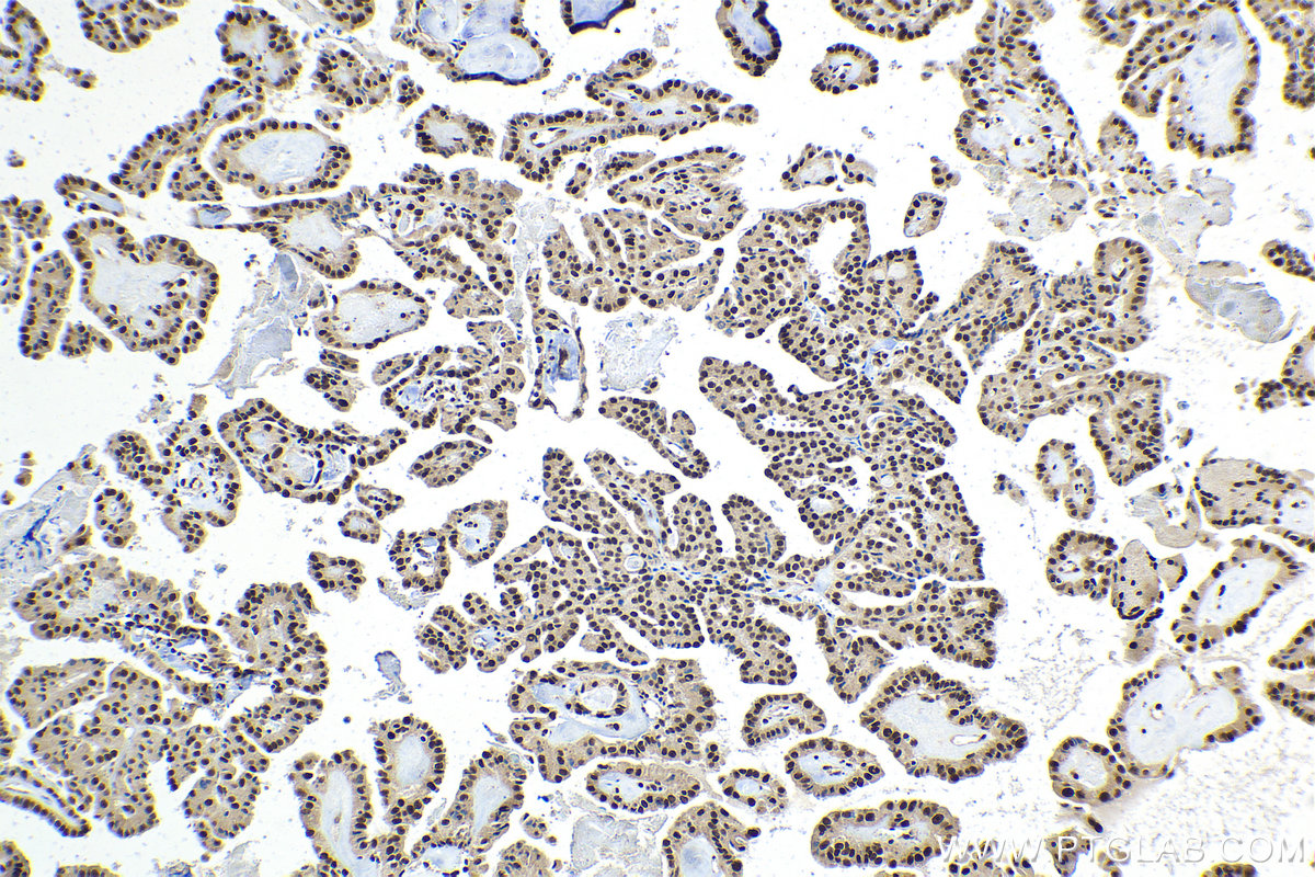 Immunohistochemical analysis of paraffin-embedded human thyroid cancer tissue slide using KHC1561 (SP100 IHC Kit).