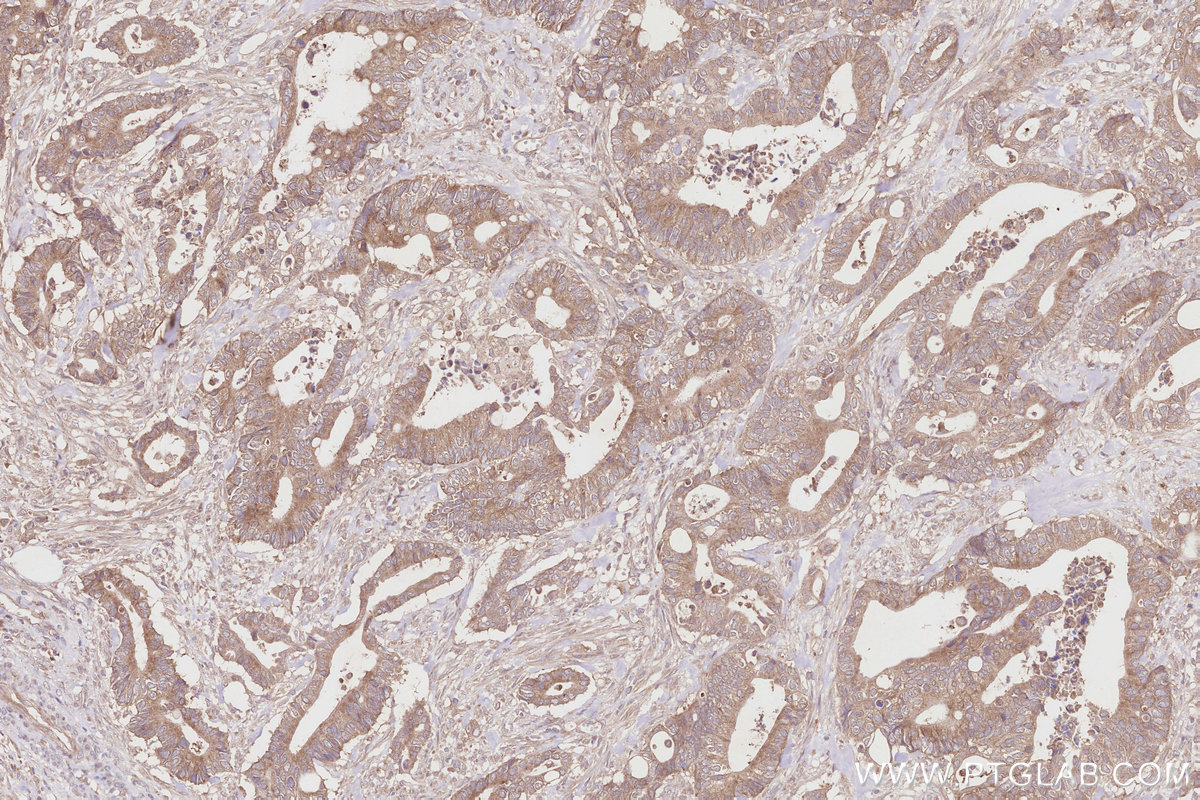 Immunohistochemical analysis of paraffin-embedded human rectal cancer tissue slide using KHC2837 (SPATA13 IHC Kit).