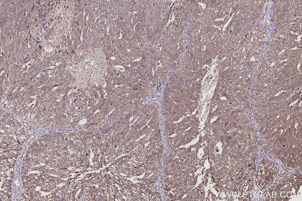 Immunohistochemical analysis of paraffin-embedded human ovary cancer tissue slide using KHC2930 (SPC25 IHC Kit).