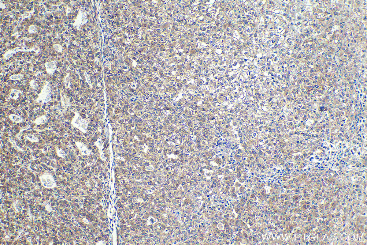 Immunohistochemical analysis of paraffin-embedded human endometrial cancer tissue slide using KHC1961 (SPHK2 IHC Kit).