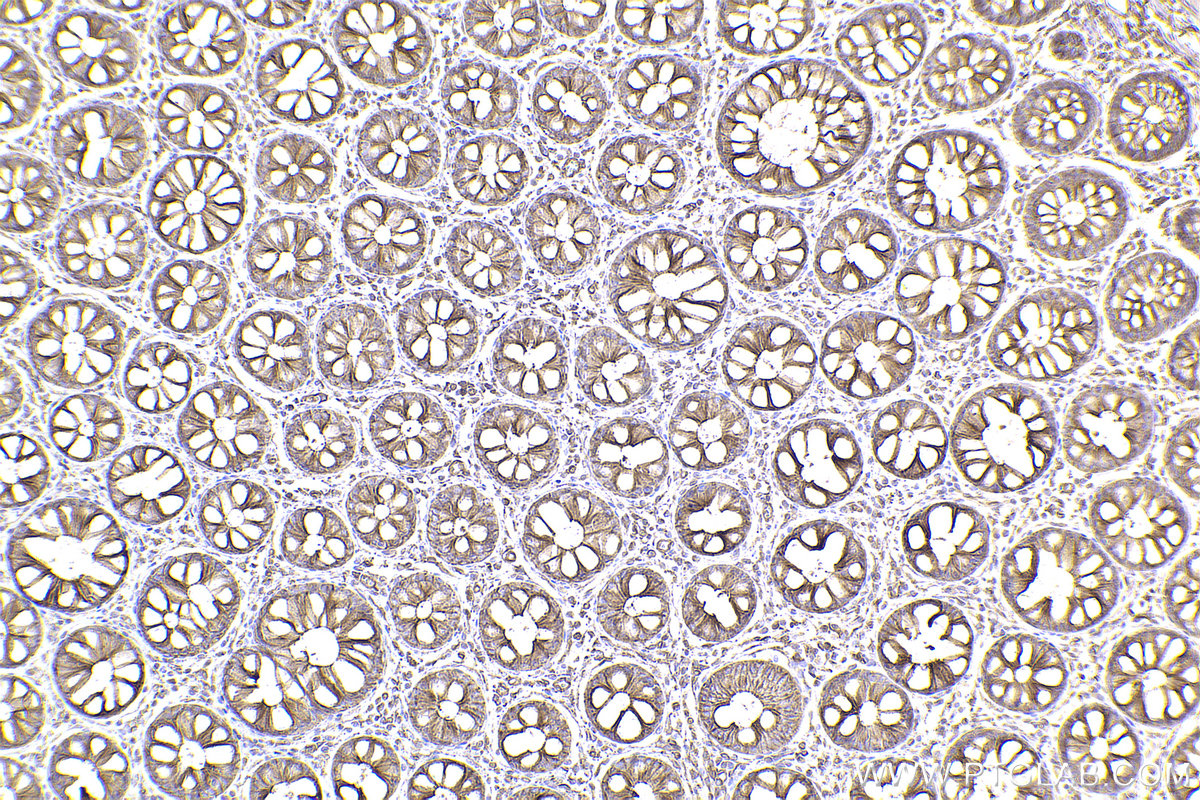 Immunohistochemical analysis of paraffin-embedded human rectal cancer tissue slide using KHC2442 (SPTAN1 IHC Kit).