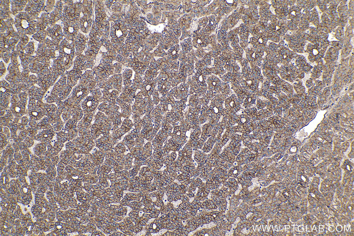 Immunohistochemical analysis of paraffin-embedded human liver cancer tissue slide using KHC0283 (SPTBN1 IHC Kit).