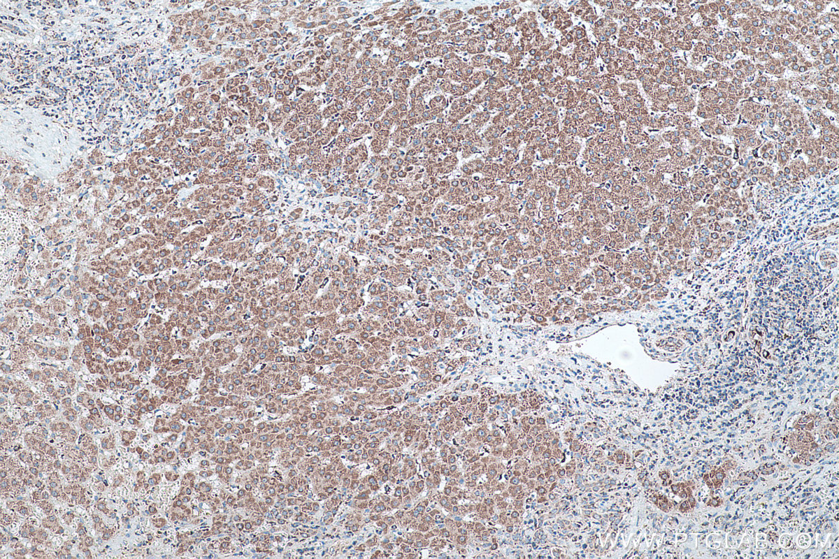 Immunohistochemical analysis of paraffin-embedded human liver cancer tissue slide using KHC0466 (SQRDL IHC Kit).