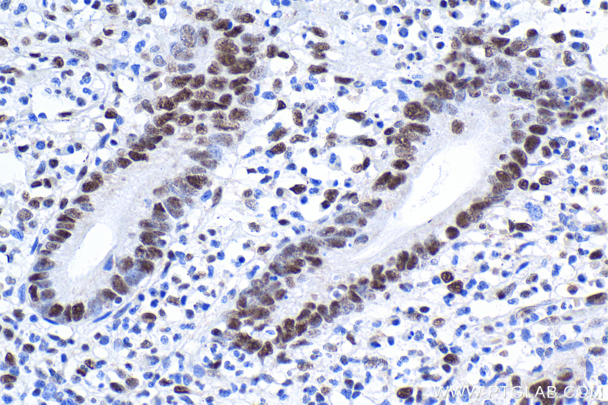 Immunohistochemical analysis of paraffin-embedded human appendicitis tissue slide using KHC1907 (SRRT IHC Kit).