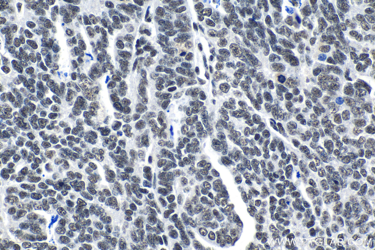 Immunohistochemical analysis of paraffin-embedded human ovary tumor tissue slide using KHC1396 (SRSF1 IHC Kit).