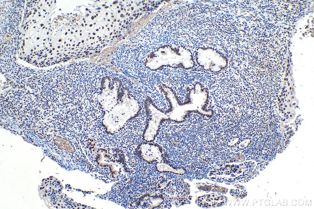 Immunohistochemical analysis of paraffin-embedded human cervical cancer tissue slide using KHC1707 (SRSF9/SFRS9 IHC Kit).