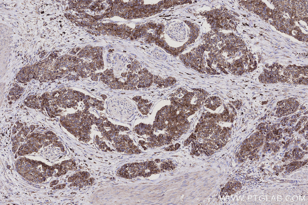 Immunohistochemical analysis of paraffin-embedded human stomach cancer tissue slide using KHC3121 (SSR3 IHC Kit).