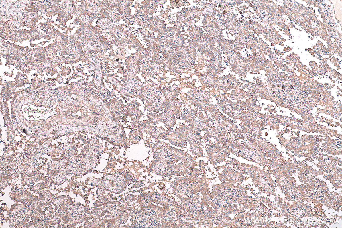 Immunohistochemical analysis of paraffin-embedded human lung cancer tissue slide using KHC0849 (ST13 IHC Kit).