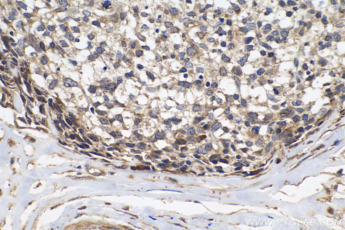 Immunohistochemical analysis of paraffin-embedded human lymphoma tissue slide using KHC0642 (ST6GAL1 IHC Kit).
