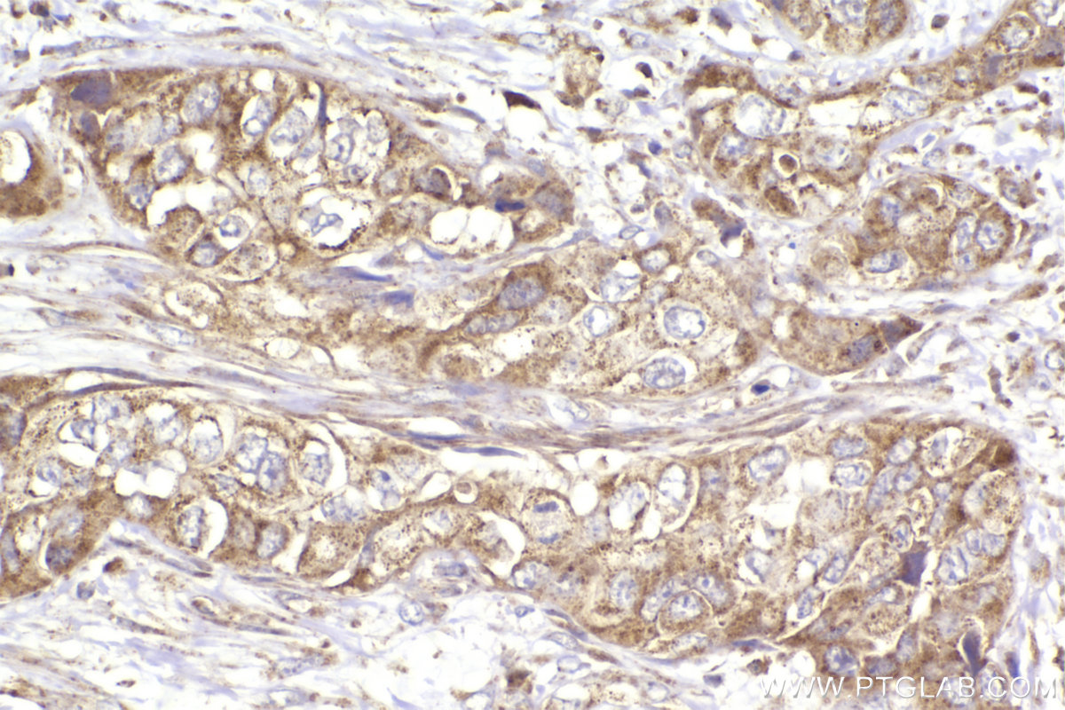 Immunohistochemical analysis of paraffin-embedded human pancreas cancer tissue slide using KHC2949 (ST7 IHC Kit).