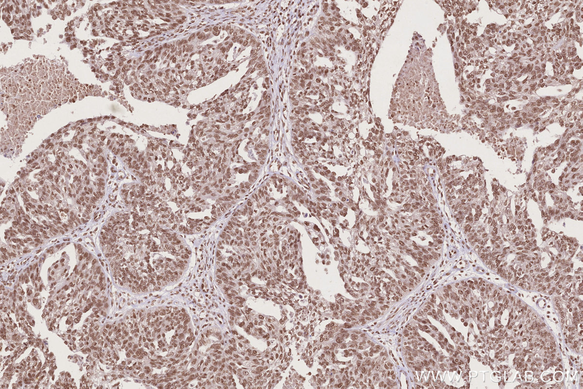 Immunohistochemical analysis of paraffin-embedded human ovary cancer tissue slide using KHC2735 (STAG1 IHC Kit).
