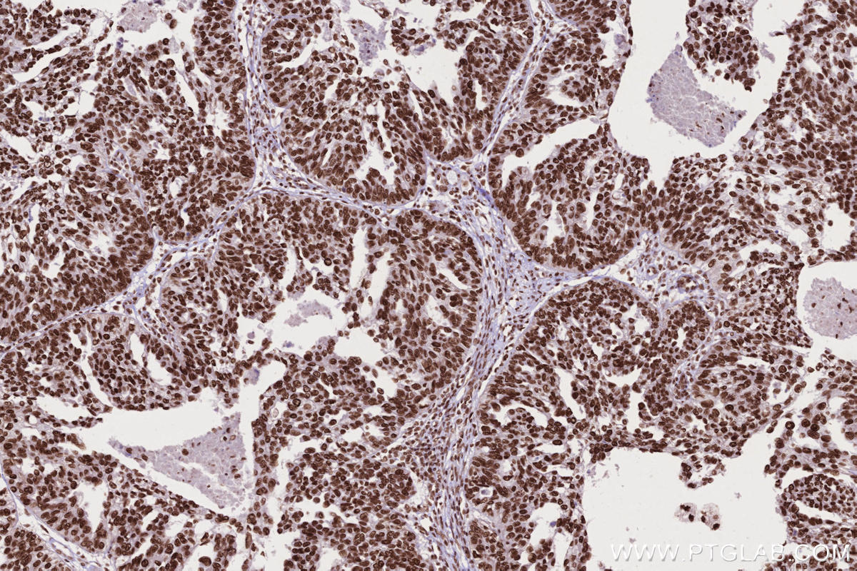 Immunohistochemical analysis of paraffin-embedded human ovary cancer tissue slide using KHC2673 (STAG2 IHC Kit).
