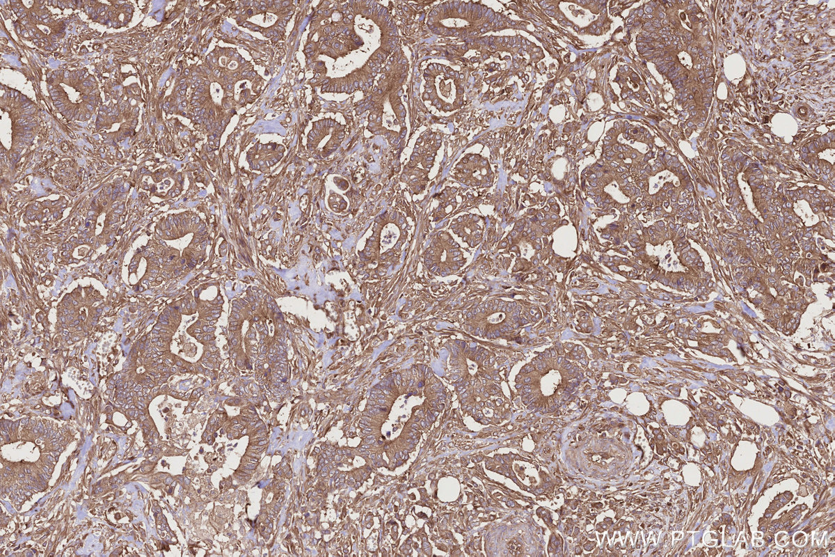 Immunohistochemical analysis of paraffin-embedded human rectal cancer tissue slide using KHC2754 (STAM IHC Kit).