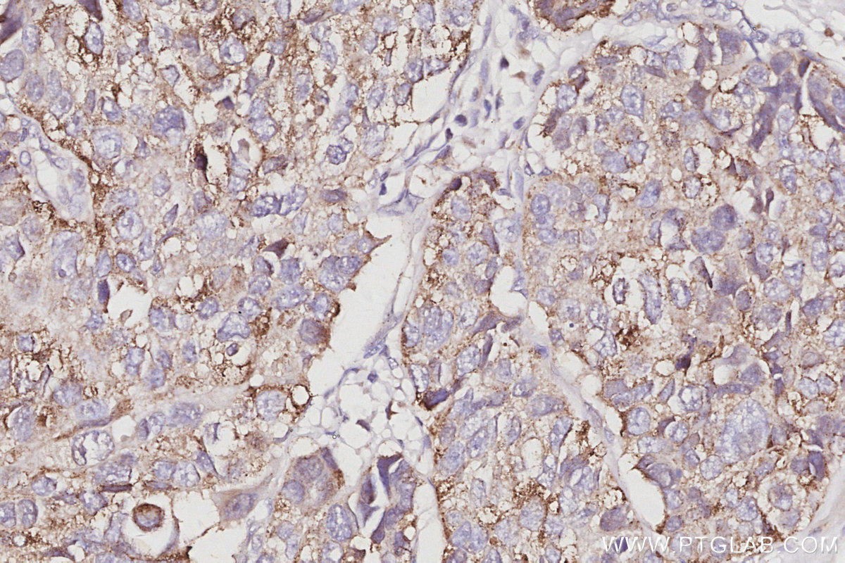 Immunohistochemical analysis of paraffin-embedded human stomach cancer tissue slide using KHC3065 (STARD13 IHC Kit).