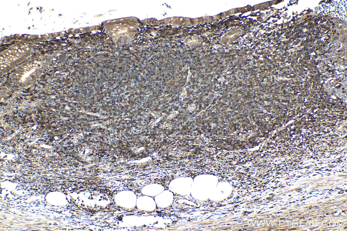 Immunohistochemical analysis of paraffin-embedded human appendicitis tissue slide using KHC1036 (STAT1 IHC Kit).