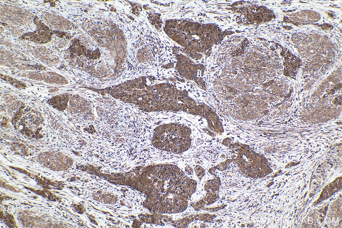 Immunohistochemical analysis of paraffin-embedded human urothelial carcinoma tissue slide using KHC1622 (STAT2 IHC Kit).