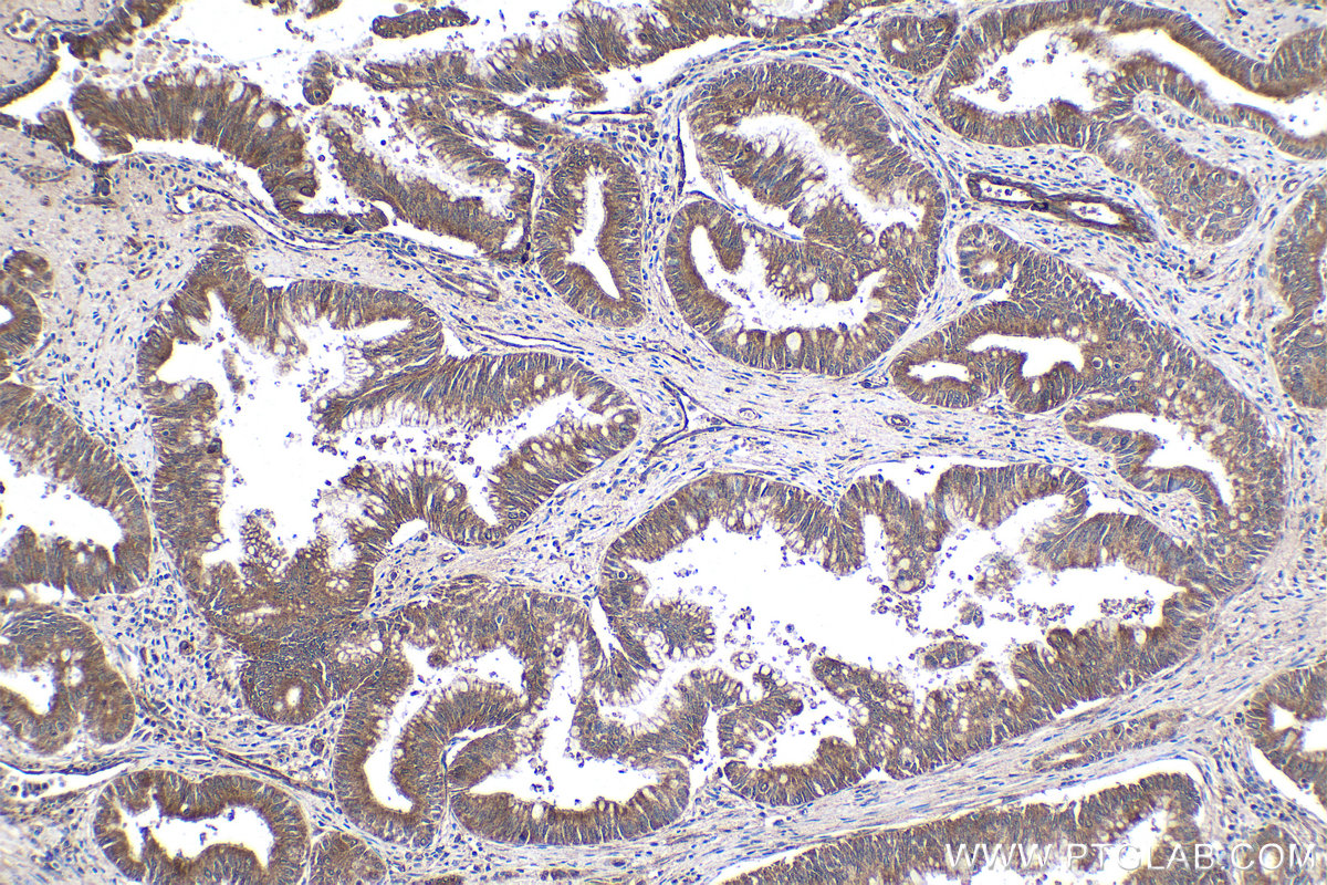 Immunohistochemical analysis of paraffin-embedded human pancreas cancer tissue slide using KHC1736 (STAT4 IHC Kit).