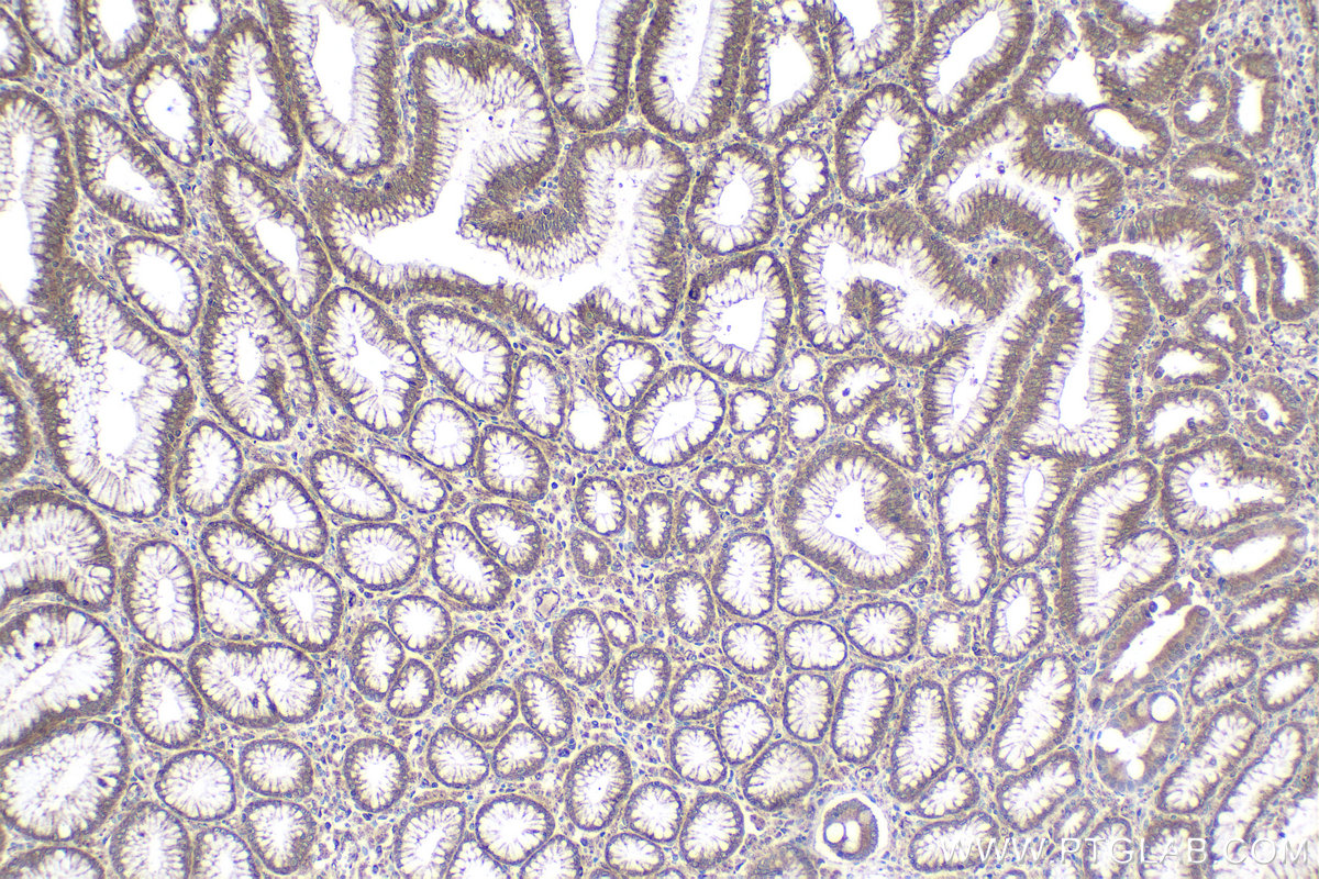 Immunohistochemical analysis of paraffin-embedded human stomach cancer tissue slide using KHC1736 (STAT4 IHC Kit).