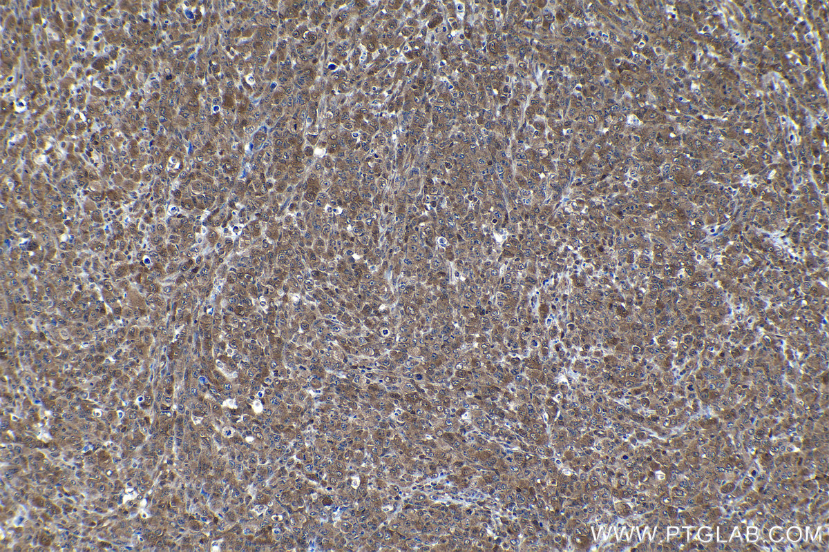 Immunohistochemical analysis of paraffin-embedded human lymphoma tissue slide using KHC1151 (STAT6 IHC Kit).