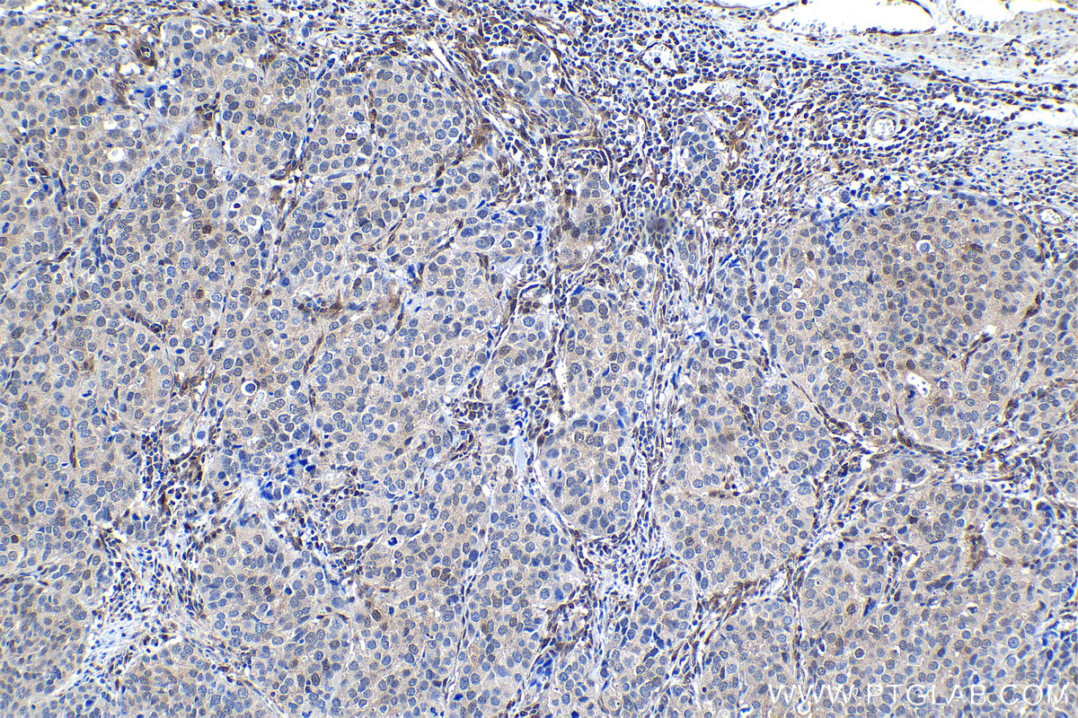 Immunohistochemical analysis of paraffin-embedded human stomach cancer tissue slide using KHC1151 (STAT6 IHC Kit).