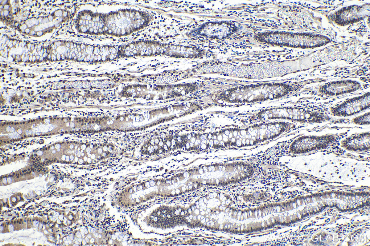 Immunohistochemical analysis of paraffin-embedded human stomach cancer tissue slide using KHC1151 (STAT6 IHC Kit).