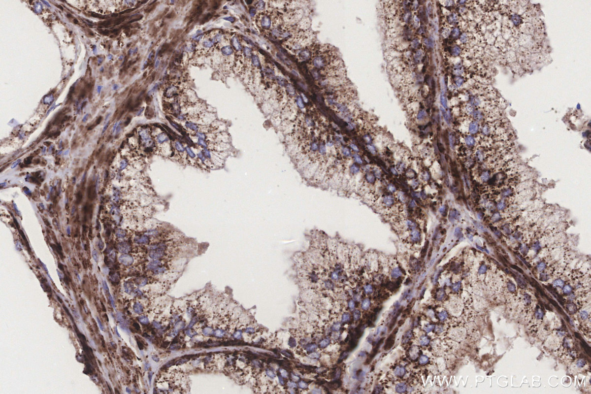 Immunohistochemical analysis of paraffin-embedded human prostate cancer tissue slide using KHC3300 (STEAP2 IHC Kit). Immunohistochemical analysis of paraffin-embedded human prostate cancer tissue slide using KHC3300 (STEAP2 IHC Kit).
