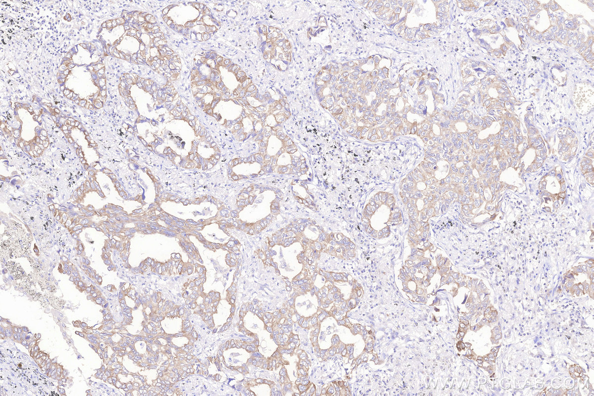Immunohistochemical analysis of paraffin-embedded human lung cancer tissue slide using KHC3267 (STEAP4 IHC Kit).