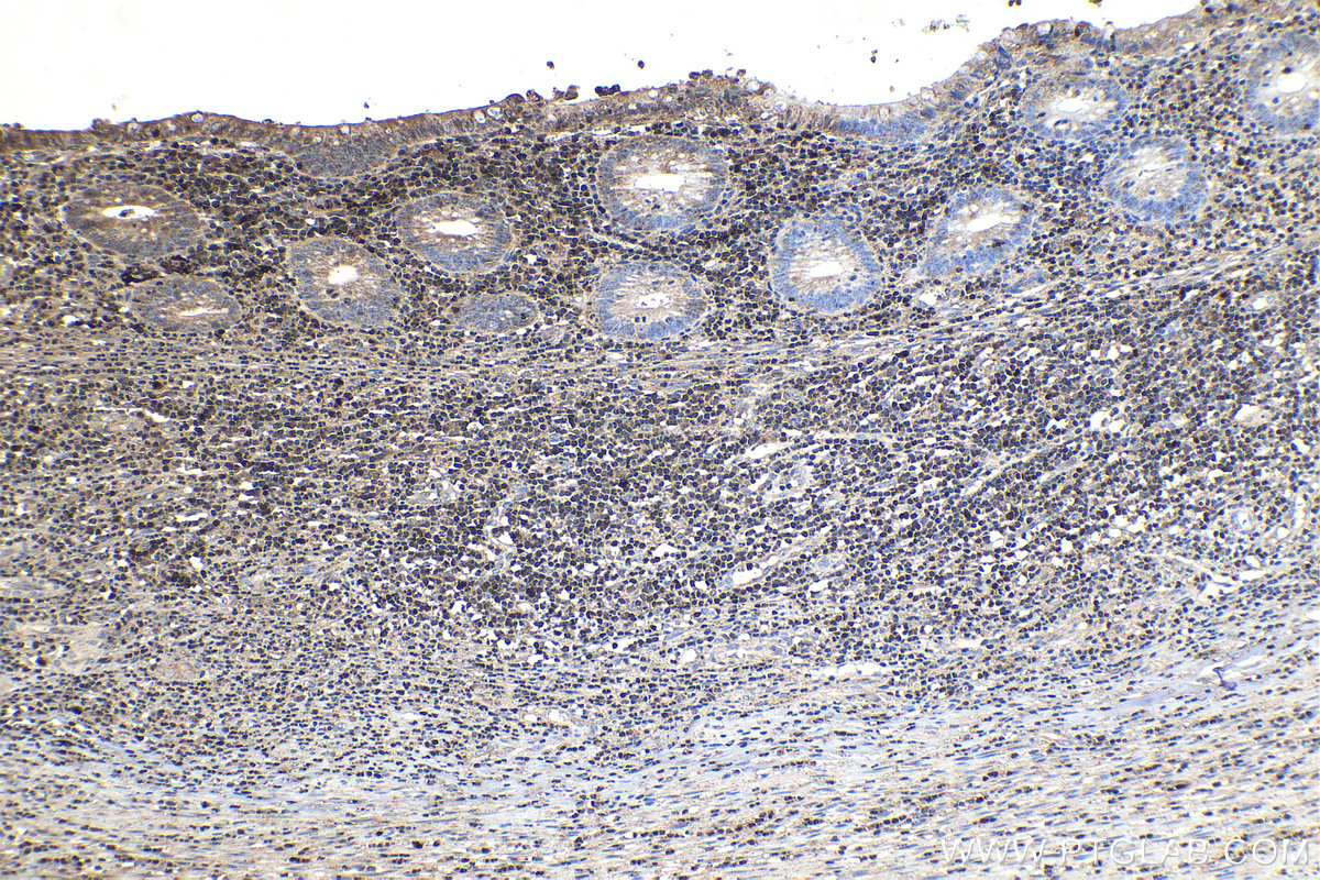 Immunohistochemical analysis of paraffin-embedded human appendicitis tissue slide using KHC1152 (STK17B IHC Kit).