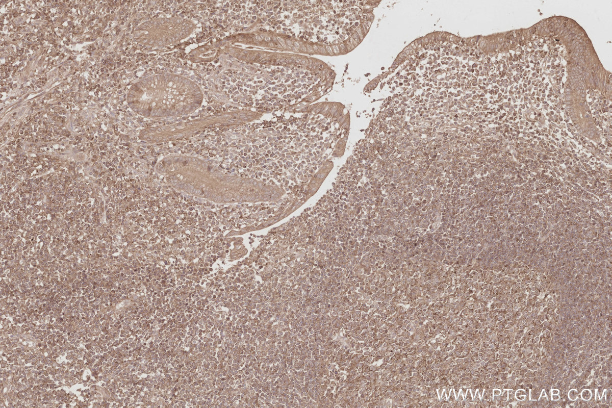Immunohistochemical analysis of paraffin-embedded human appendicitis tissue slide using KHC2888 (STK33 IHC Kit).