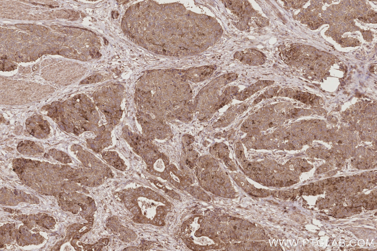 Immunohistochemical analysis of paraffin-embedded human stomach cancer tissue slide using KHC2888 (STK33 IHC Kit).