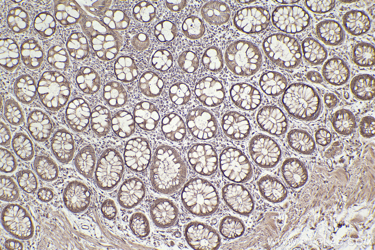 Immunohistochemical analysis of paraffin-embedded human rectal cancer tissue slide using KHC2483 (STK38 IHC Kit).