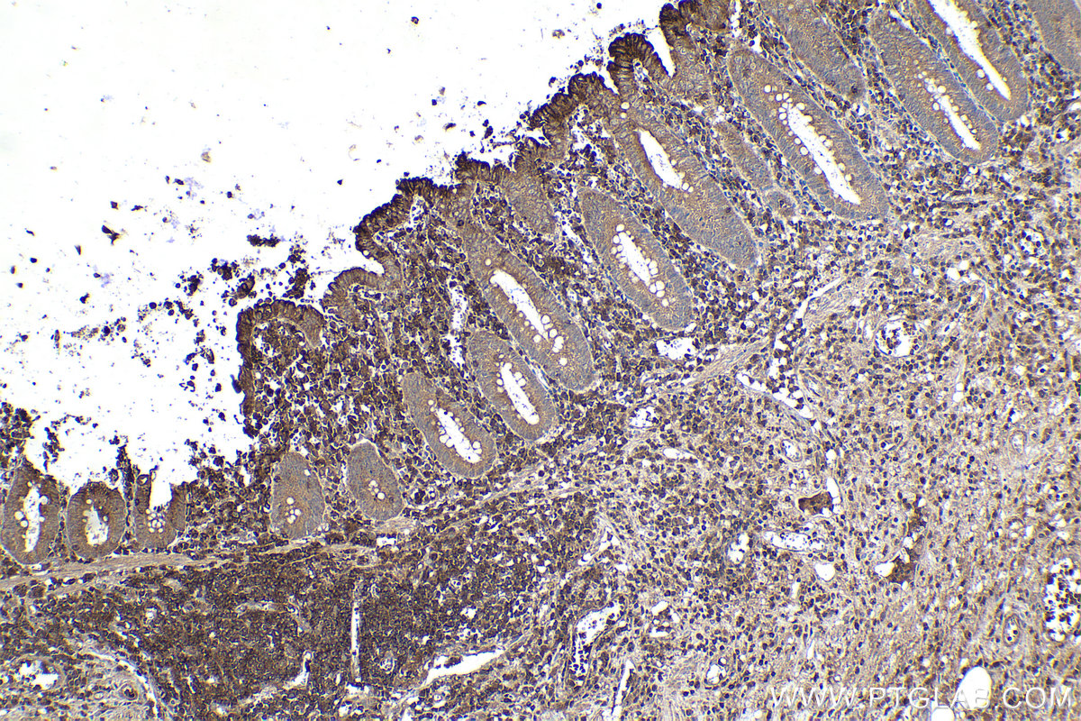 Immunohistochemical analysis of paraffin-embedded human appendicitis tissue slide using KHC1699 (STK4 IHC Kit).