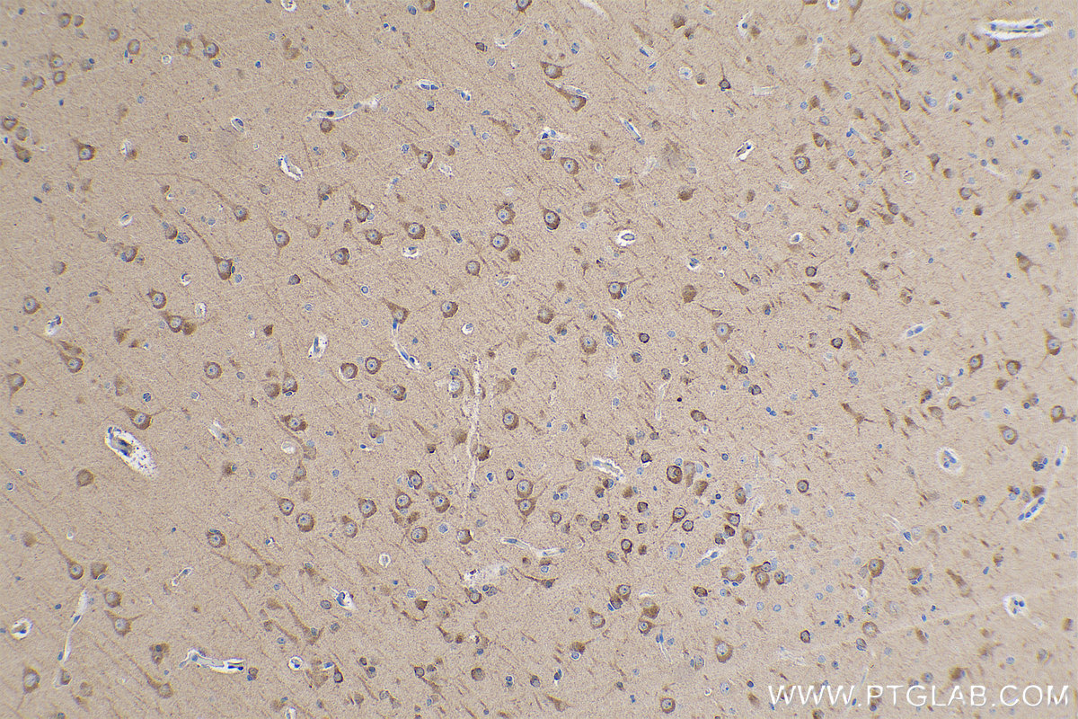 Immunohistochemical analysis of paraffin-embedded human gliomas tissue slide using KHC0841 (Stathmin 1 IHC Kit).