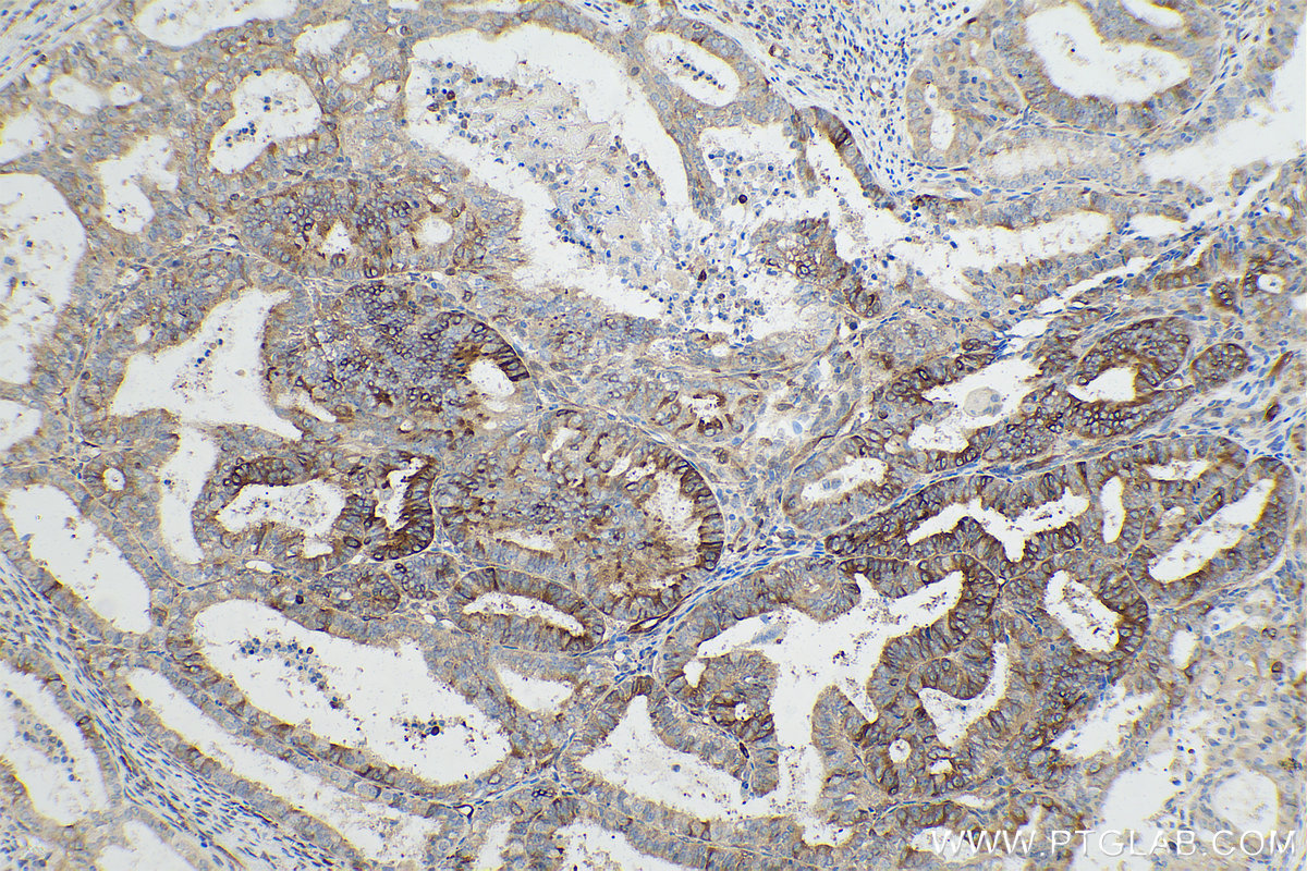 Immunohistochemical analysis of paraffin-embedded human ovary tumor tissue slide using KHC0841 (Stathmin 1 IHC Kit).