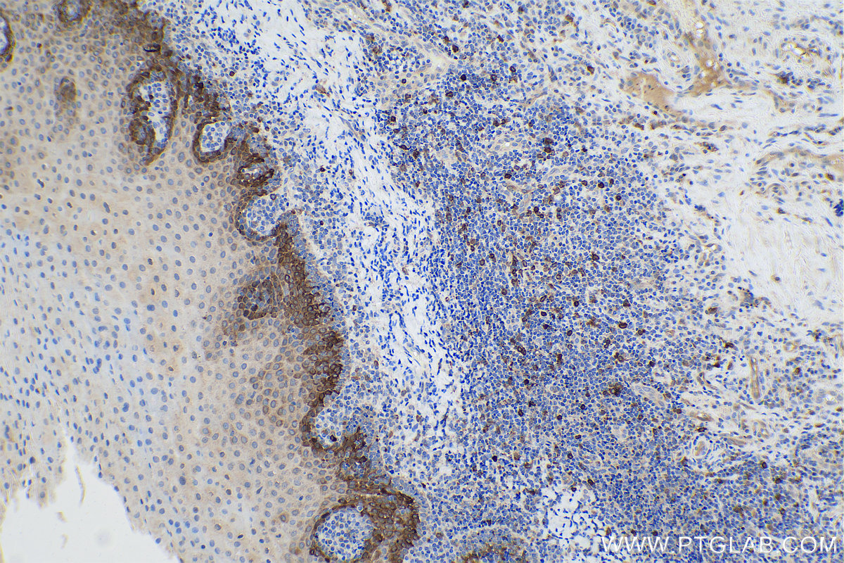 Immunohistochemical analysis of paraffin-embedded human tonsillitis tissue slide using KHC0841 (Stathmin 1 IHC Kit).