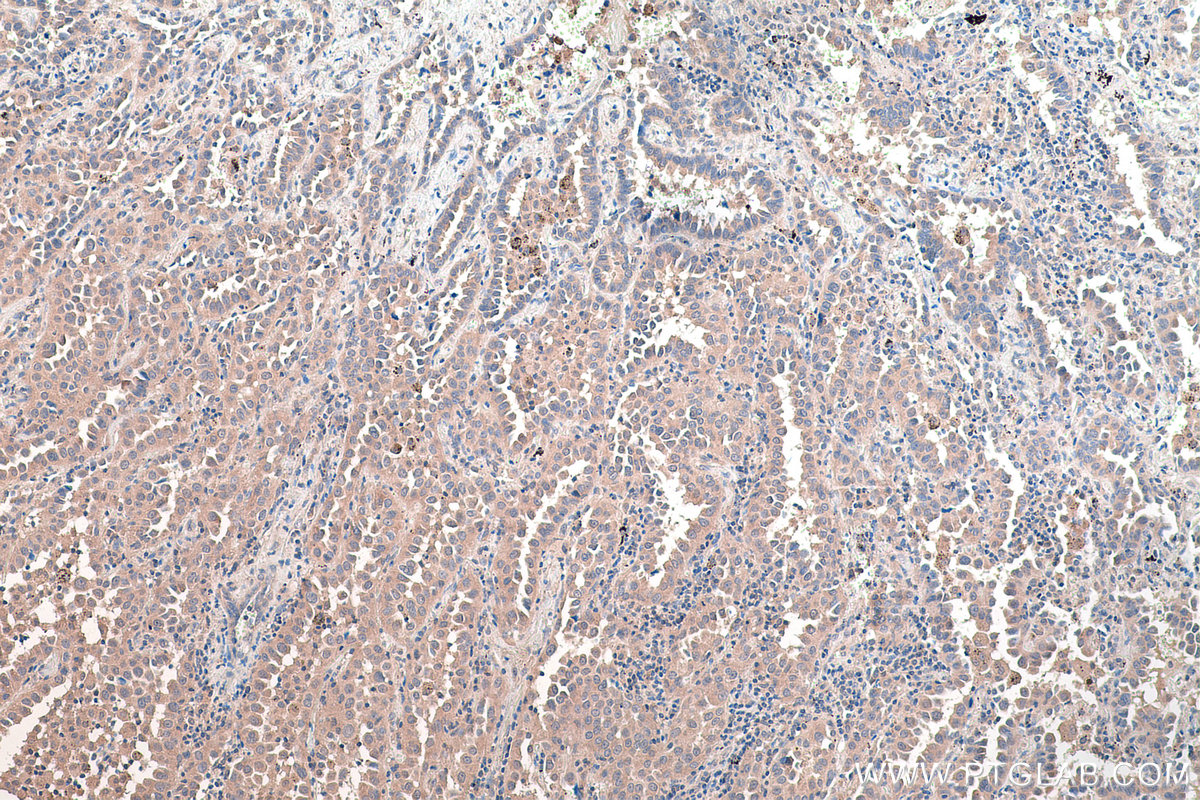 Immunohistochemical analysis of paraffin-embedded human lung cancer tissue slide using KHC0300 (STMN2 IHC Kit).