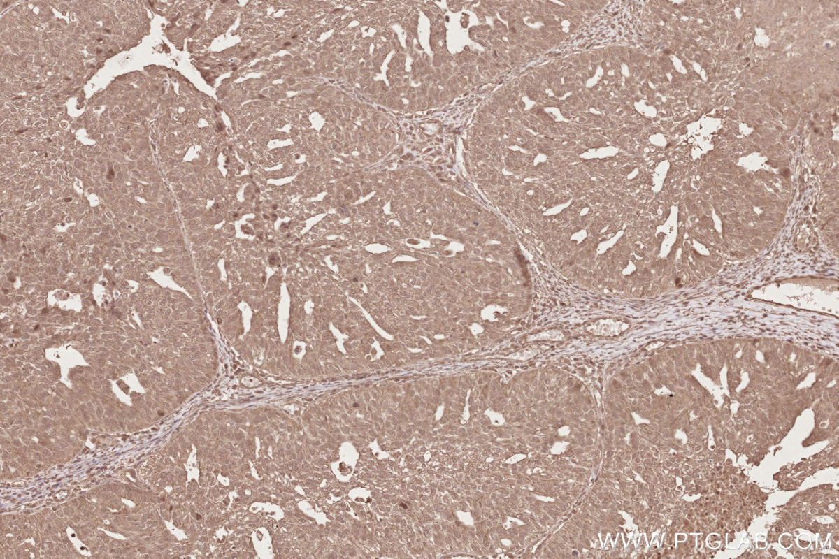 Immunohistochemical analysis of paraffin-embedded human ovary cancer tissue slide using KHC2628 (STRA8 IHC Kit).